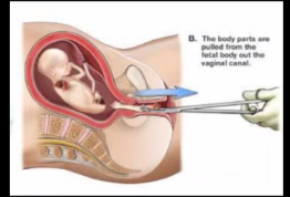 sb-95-kansas-dismemberment-abortion-dilation-and-evacuation.png